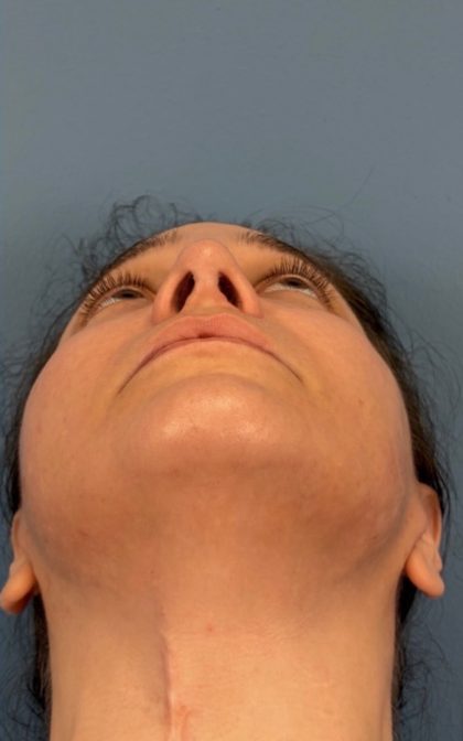 Browlift Before & After Patient #16917