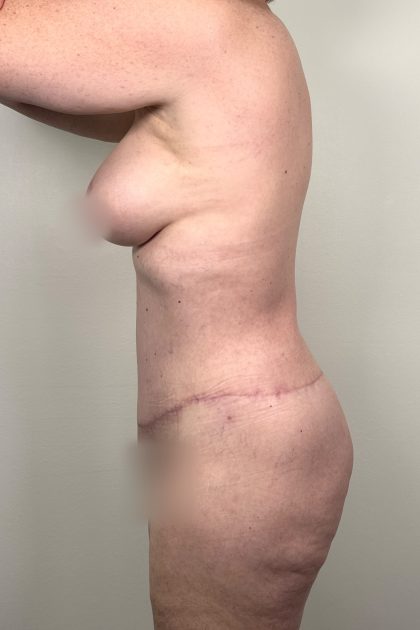 Breast Augmentation Before & After Patient #16980