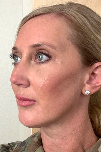 Blepharoplasty Before & After Patient #16982