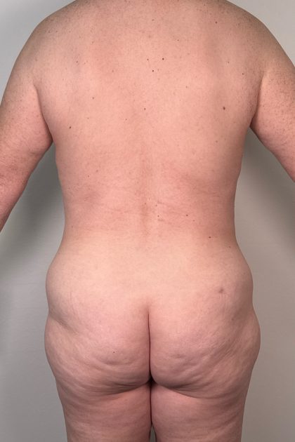 Breast Augmentation Before & After Patient #16980