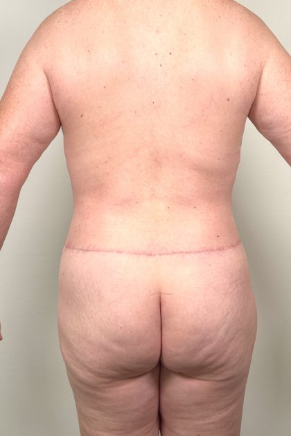 Breast Augmentation Before & After Patient #16980