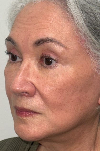 Blepharoplasty Before & After Patient #16983