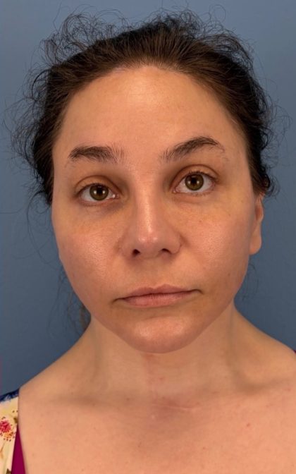 Browlift Before & After Patient #16917