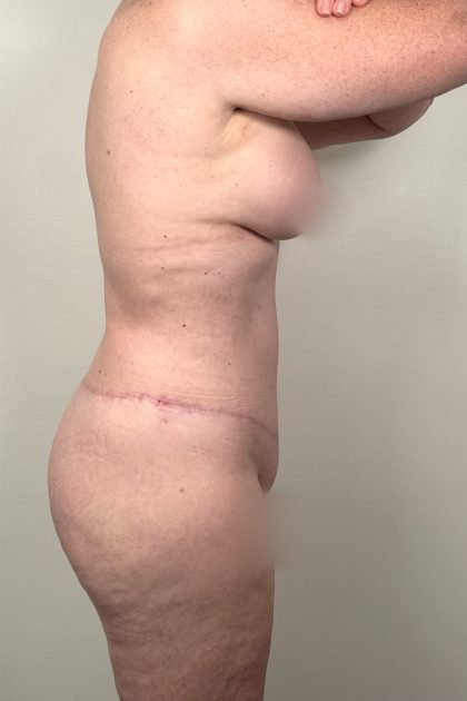 Breast Augmentation Before & After Patient #16980