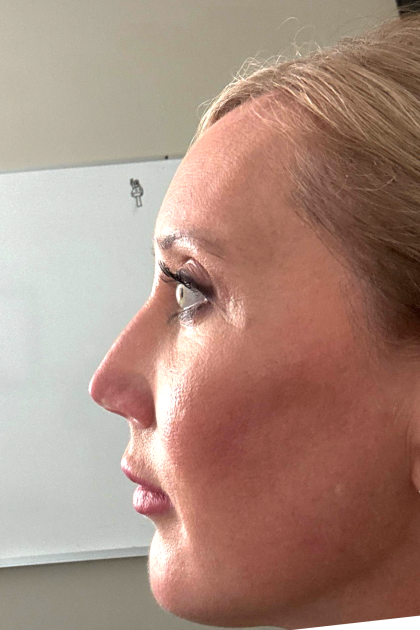 Blepharoplasty Before & After Patient #16982