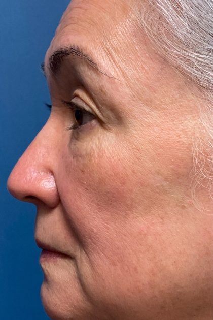Blepharoplasty Before & After Patient #16983