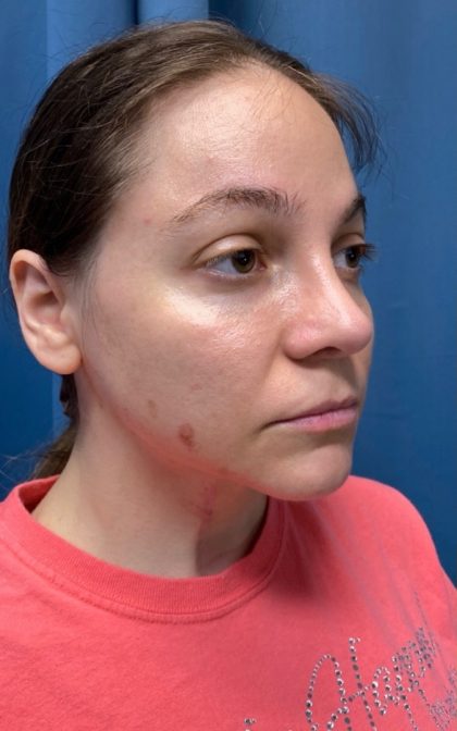Browlift Before & After Patient #16917