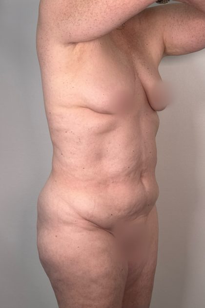 Breast Augmentation Before & After Patient #16980