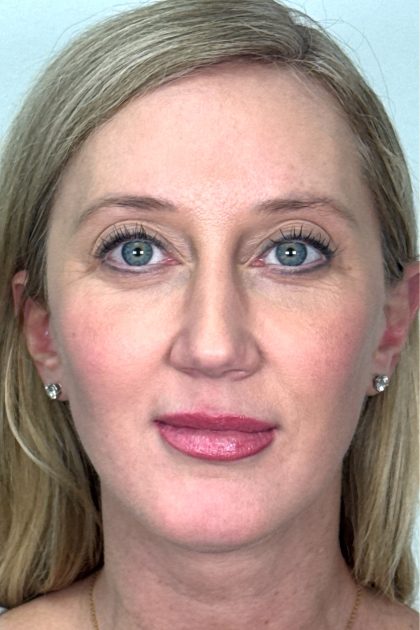Blepharoplasty Before & After Patient #16982