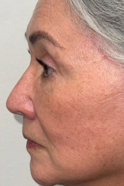 Blepharoplasty Before & After Patient #16983