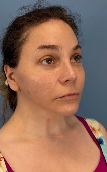 Browlift Before & After Patient #16917
