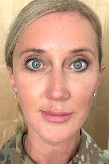 Blepharoplasty Before & After Patient #16982