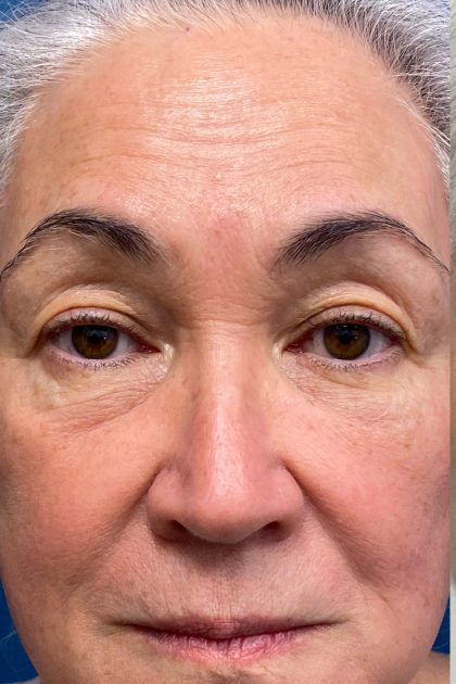 Blepharoplasty Before & After Patient #16983