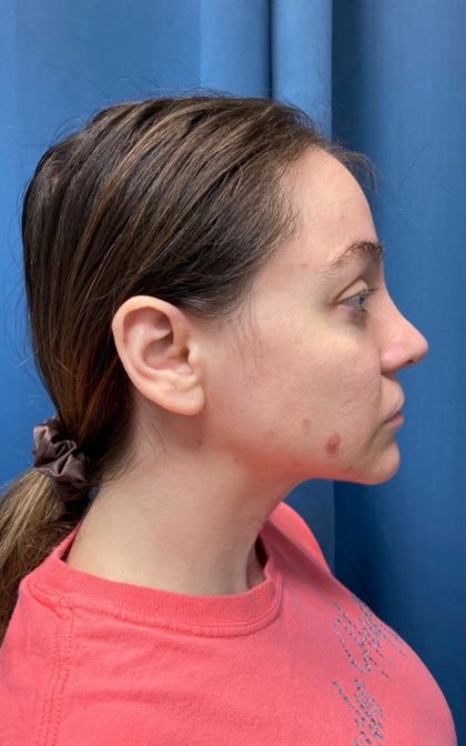 Browlift Before & After Patient #16917