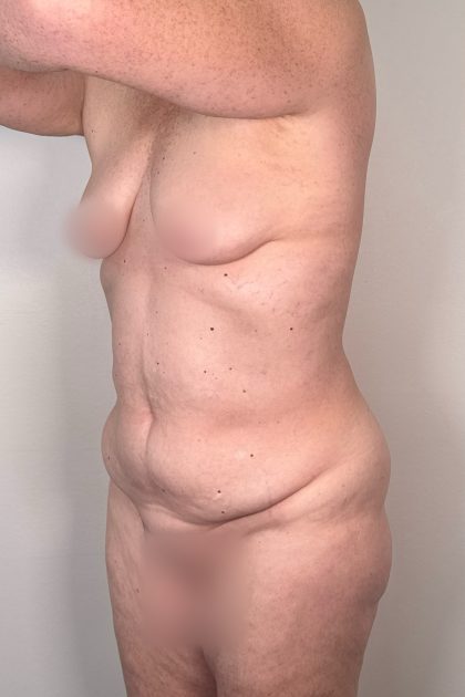 Breast Augmentation Before & After Patient #16980