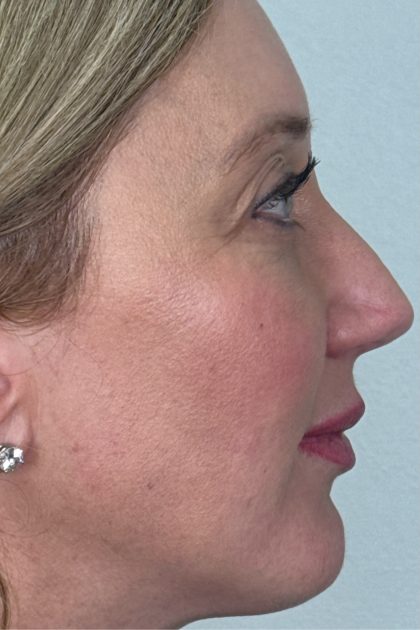 Blepharoplasty Before & After Patient #16982