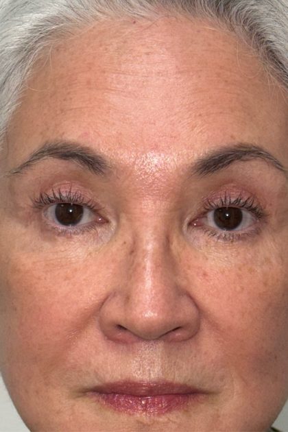 Blepharoplasty Before & After Patient #16983