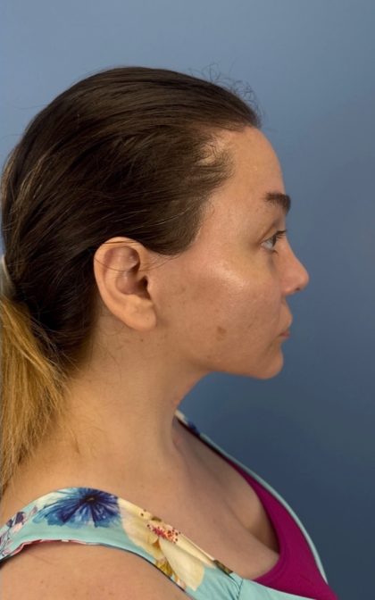 Browlift Before & After Patient #16917
