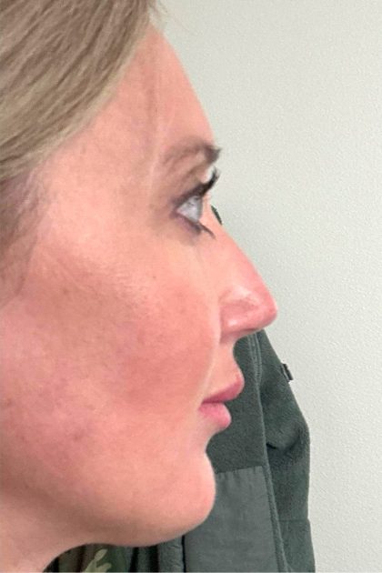 Blepharoplasty Before & After Patient #16982