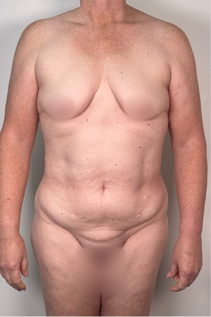 Breast Augmentation Before & After Patient #16980