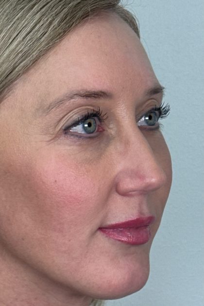 Blepharoplasty Before & After Patient #16982