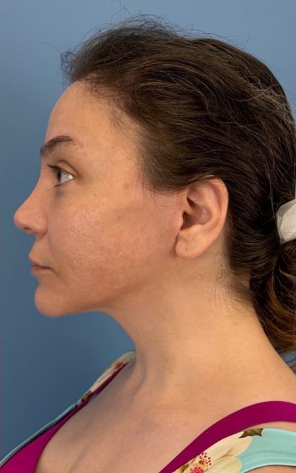 Browlift Before & After Patient #16917