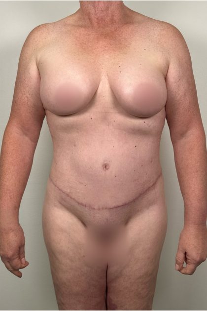 Breast Augmentation Before & After Patient #16980