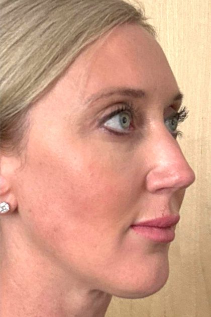 Blepharoplasty Before & After Patient #16982