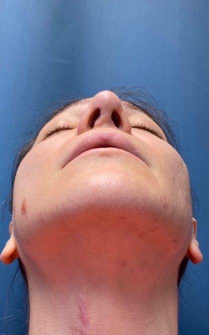 Browlift Before & After Patient #16917