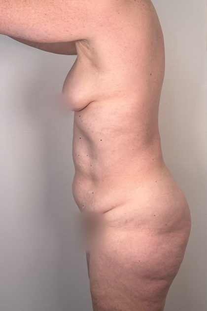 Breast Augmentation Before & After Patient #16980