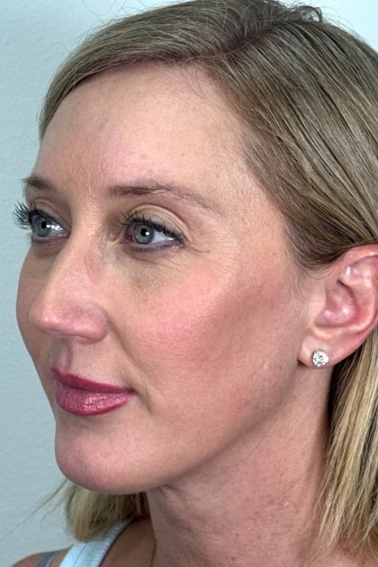 Blepharoplasty Before & After Patient #16982