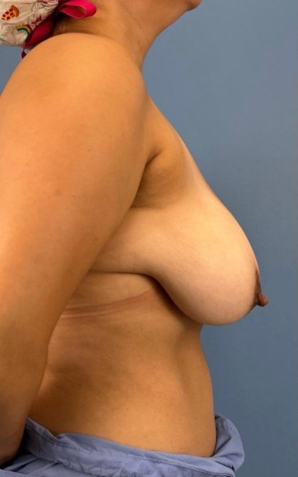 Breast Lift/Mastopexy Before & After Patient #16886
