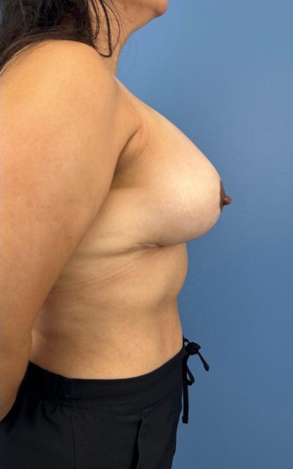 Breast Lift/Mastopexy Before & After Patient #16886