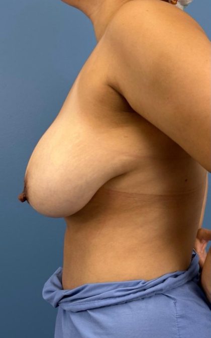 Breast Lift/Mastopexy Before & After Patient #16886