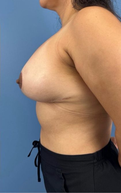 Breast Lift/Mastopexy Before & After Patient #16886