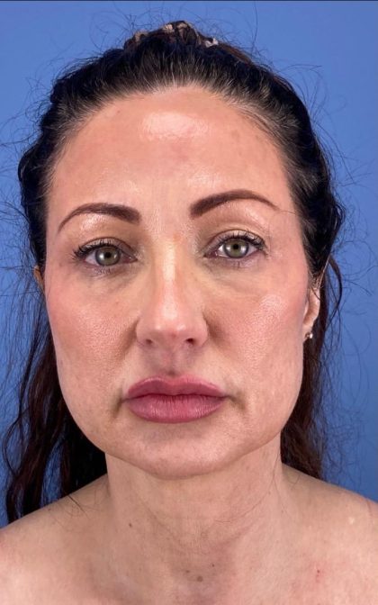 Browlift Before & After Patient #16874