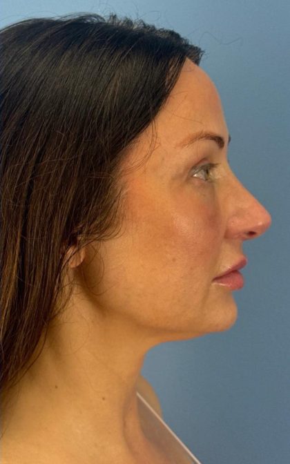 Browlift Before & After Patient #16874