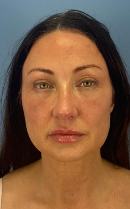 Browlift Before & After Patient #16874