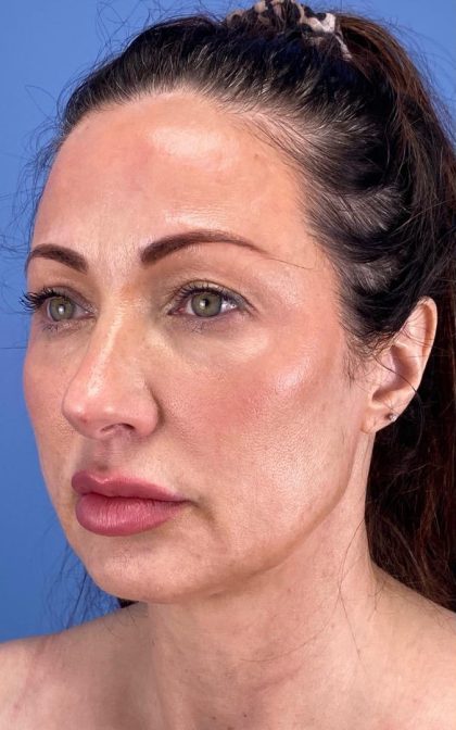 Browlift Before & After Patient #16874