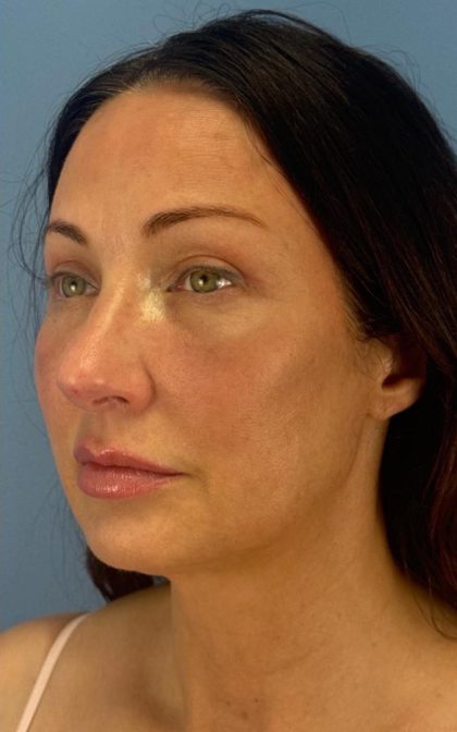 Browlift Before & After Patient #16874
