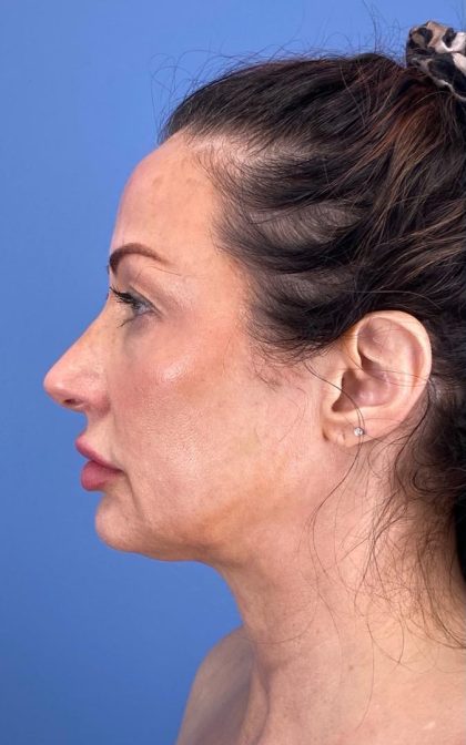 Browlift Before & After Patient #16874