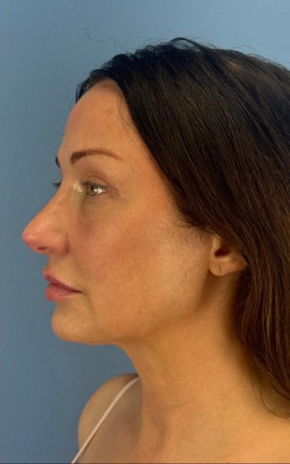 Browlift Before & After Patient #16874