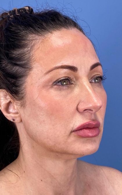 Browlift Before & After Patient #16874