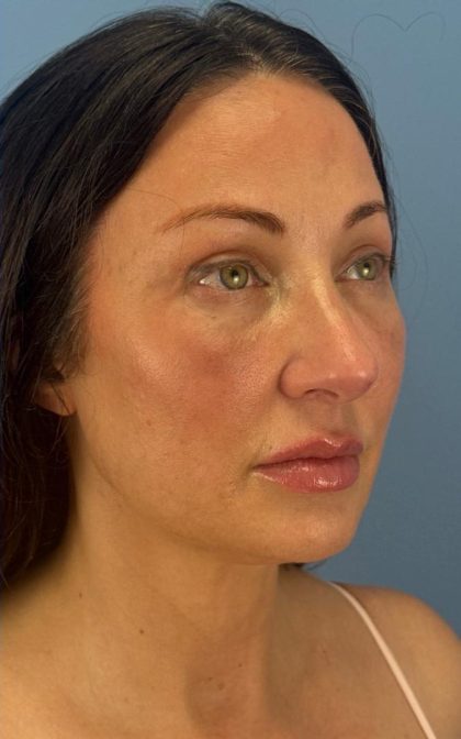 Browlift Before & After Patient #16874