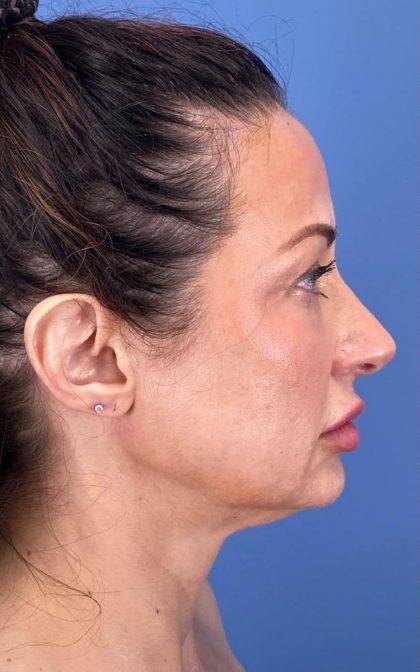Browlift Before & After Patient #16874