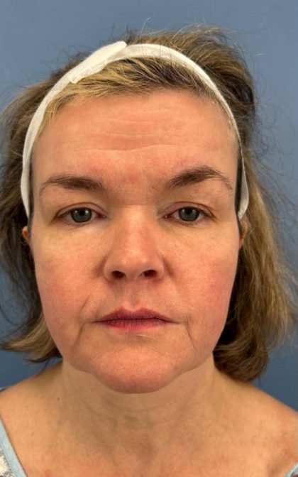 Facelift and Necklift Before & After Patient #16863