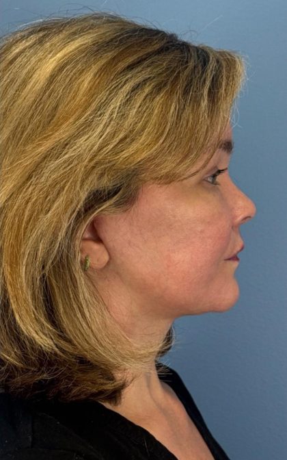 Facelift and Necklift Before & After Patient #16863