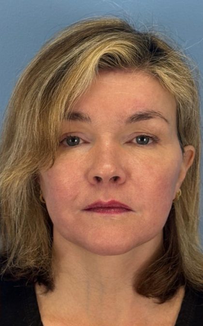 Facelift and Necklift Before & After Patient #16863