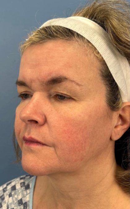 Facelift and Necklift Before & After Patient #16863