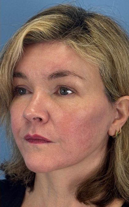 Facelift and Necklift Before & After Patient #16863